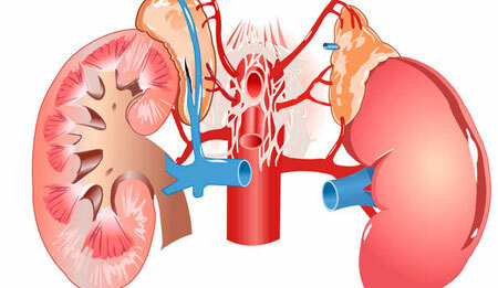 Treatment of kidney hydronephrosis