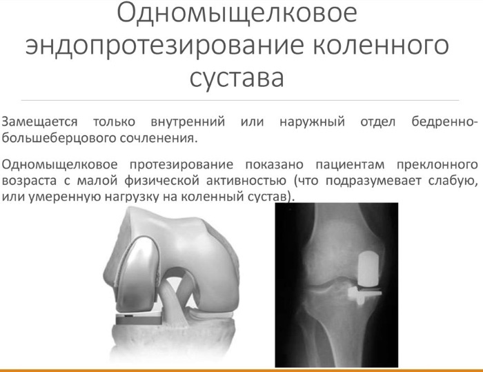 Knee endoprosthesis. Price, types, x-rays, service life, where to buy, photos, reviews. Zimmer, Stryker, Biomet
