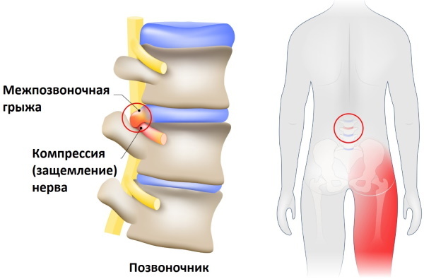 Zovretý nerv v dolnej časti chrbta. Príznaky u žien, liečba