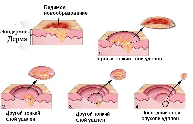 Neoplasmer på ansigtets hud, arme, hals, balder, fødder, hoved. Typer, årsager, laserfjerning