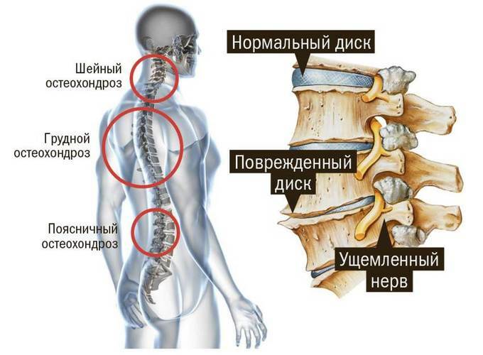Lumbar osteochondrosis. Symptoms and treatment drugs, gymnastics