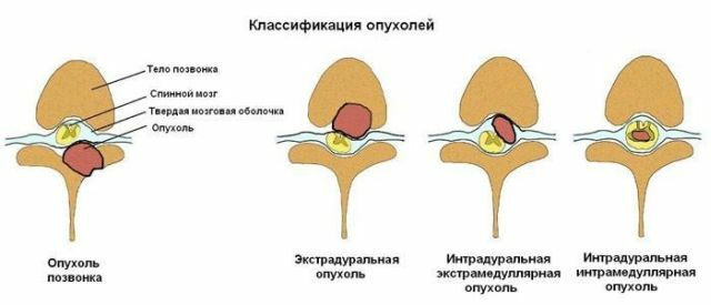 סוגים שונים של גידולים של חוט השדרה
