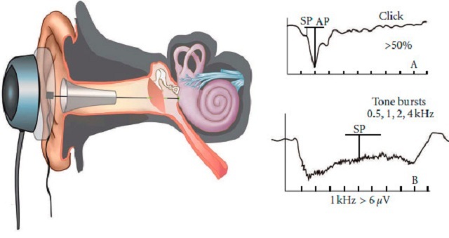 Électrocochlearographie du nerf auditif