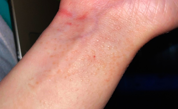 Pimples on the wrist itch: small, watery, red. Why did they appear, photo
