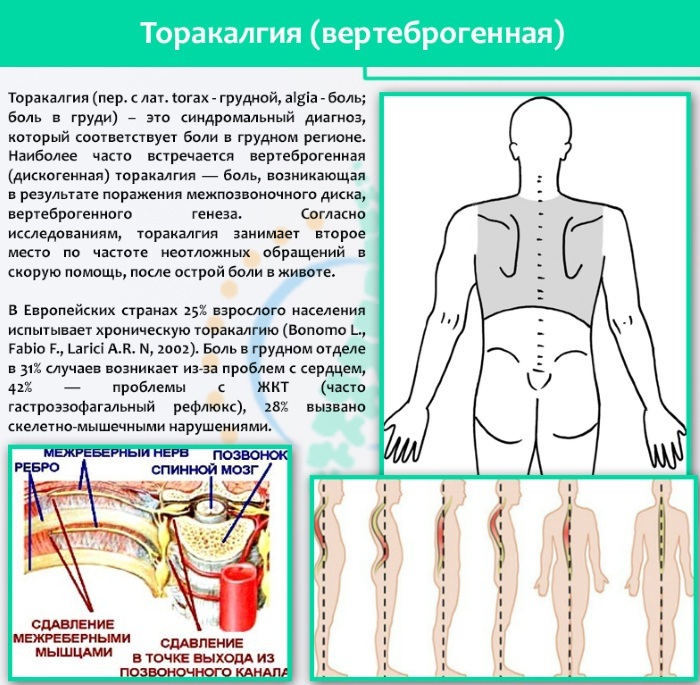 Vertebrogenic torakalgiya. What is it, the symptoms of chronic, acute, left-hand, right-hand, exercise therapy, treatment, consequences of the diagnosis