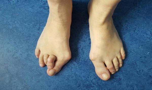 Protin na nogah. Fotografija, zdravljenje, tablete, alternativne metode