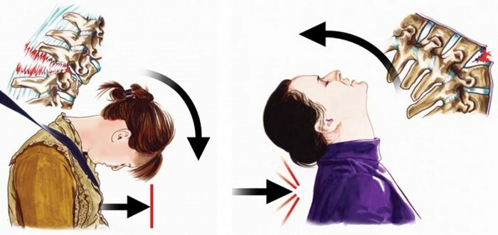 Fractuur van de halswervel. Gevolgen, symptomen 1-2-3-4-5-6-7, behandeling