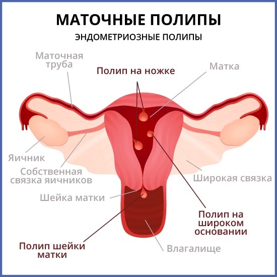 Poliep in het cervixkanaal. Of is het mogelijk om zwanger te worden, de behandeling, bloeden tijdens de zwangerschap, een operatie, het verwijderen, curettage