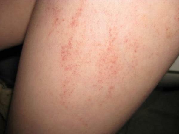 Norwegian Scabies: Symptoms and Treatment