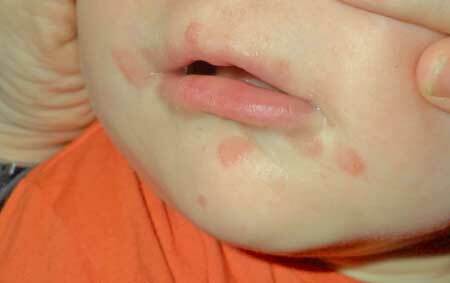 Treatment of the Coxsackie virus in children