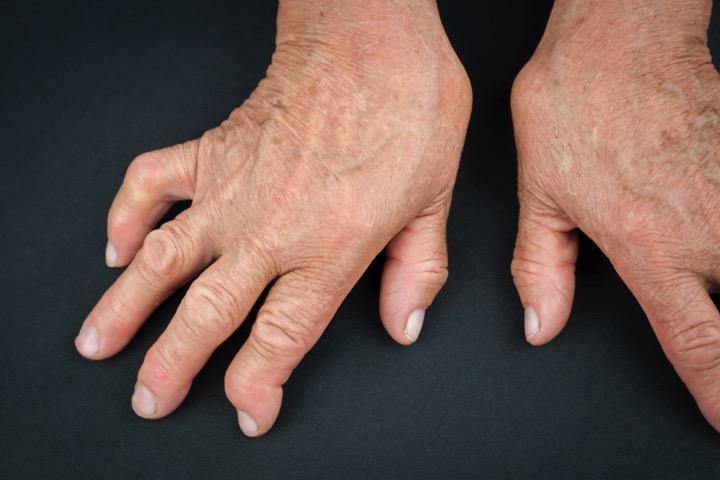 Artrite reumatóide nas mãos