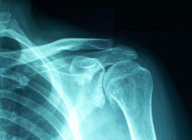 Synovitis of the shoulder joint