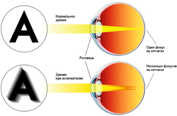 כפל ראייה. גורם, סימפטומים וטיפול במחלות עיניים, הנחיות קליניות