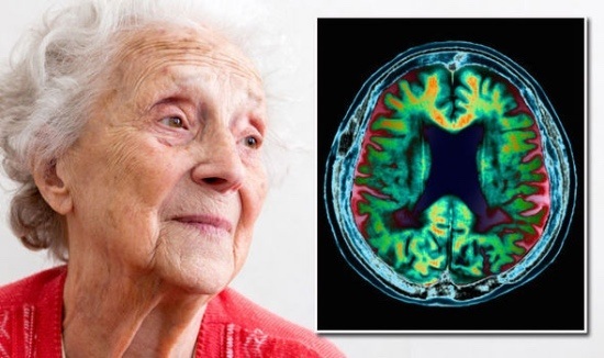 Demencia en mujeres mayores. Síntomas y tratamiento