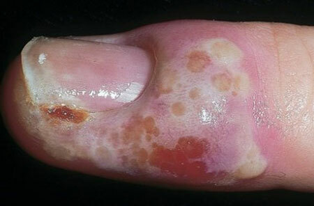 Panaritiumi sõrm käe jalgadel: ravi, foto, ravimid