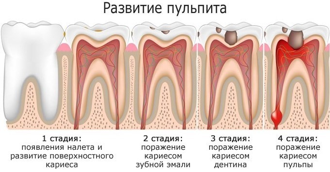 Pulpitis. Classification, diagnosis, treatment in children, adults, symptoms, causes, types