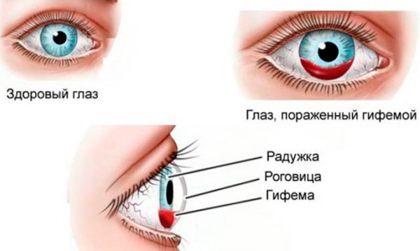 Gotas para los ojos para el sangrado ocular debido a la presión.