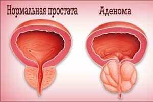 Prostatos adenoma