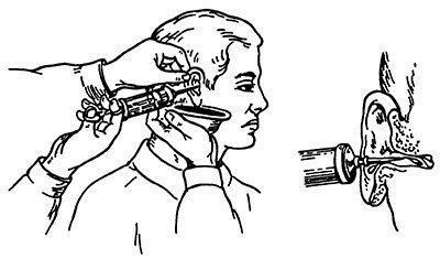 Как промыть ухо в домашних. Промывание уха шприцом жане. Инородное тело слухового прохода промывание. Техника промывания наружного слухового прохода. Шприц жане для промывания ушей.
