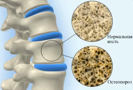 Osteoporozė