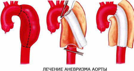 Treatment of aortic aneurysm
