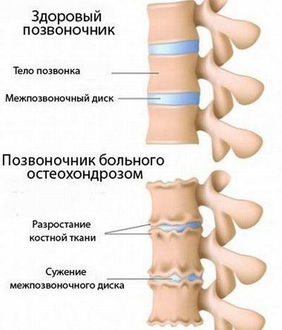 Osteohondroza v vratnem delu