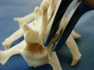 removal of vertebrae