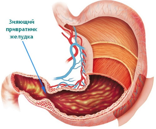 Insufficiens af cardia og pylorus i maven. Hvad er det