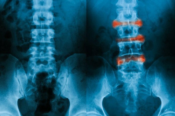 Ankylosing spondylitis. What is it, clinical guidelines, treatment