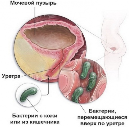 Infección del tracto urinario en niños. Síntomas, causas, tratamiento.