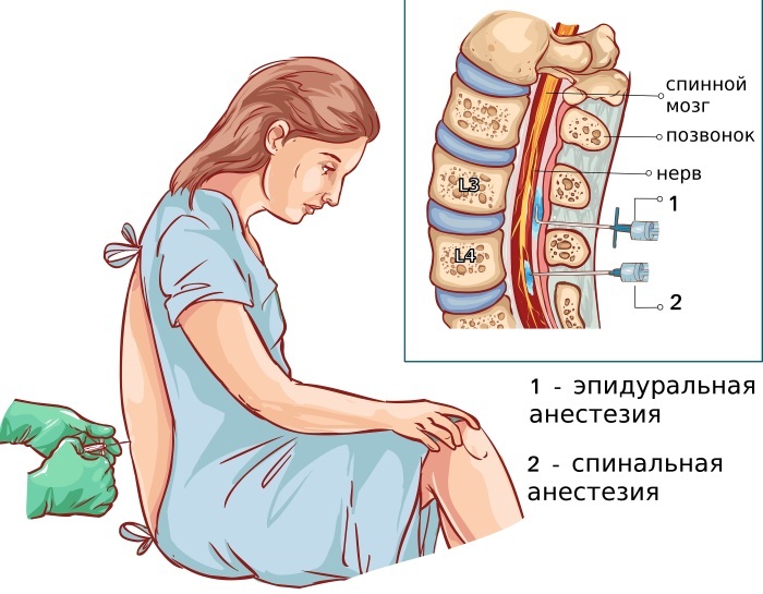 Epidural (epidural anesthesia) during childbirth. Reviews, what is it, the consequences for mom, child, contraindications