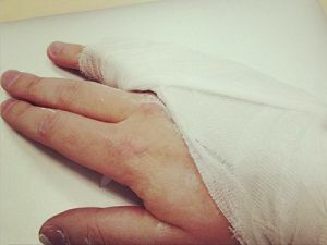 Fracture du petit doigt sur la main: le traumatisme n'est pas très dangereux, mais désagréable