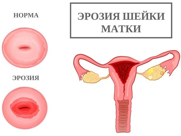 Foam in urine in women. Causes and treatment at home