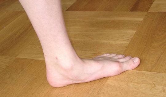 Les symptômes de flatfoot