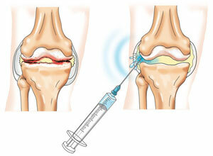 knee joint treatment
