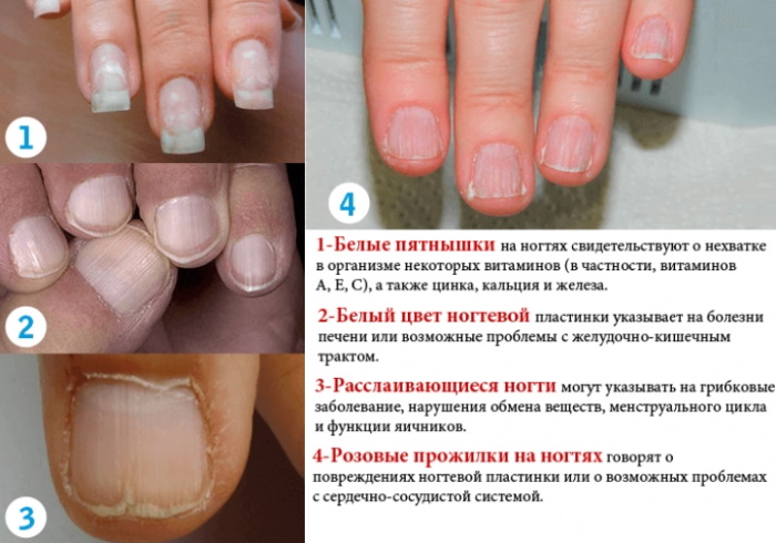 Medical nail polish after gel polish, from fungus