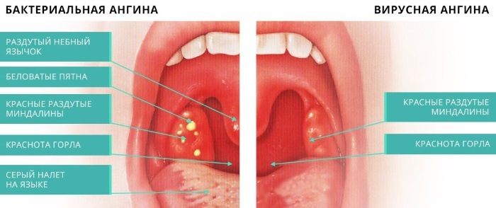 Garganta de una persona sana: foto, enfermedades de la garganta y laringe.