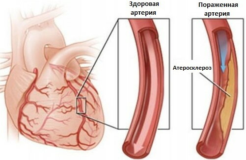 Arteriosklerose. Symptome und Anzeichen, was ist diese Krankheit?