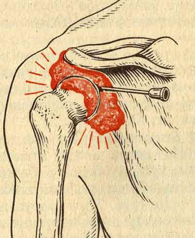 Puncture of the shoulder joint