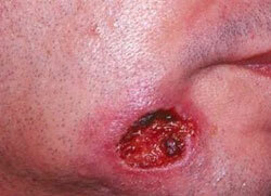 Simptomi sekundarnega sifilisa