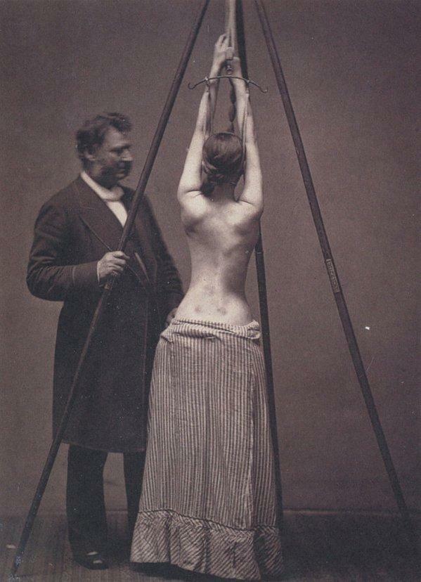 Dr. Lewis Seir memperlakukan skoliosis. Inggris.70 tahun abad XIX