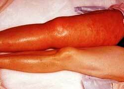 Complications de la thrombose veineuse