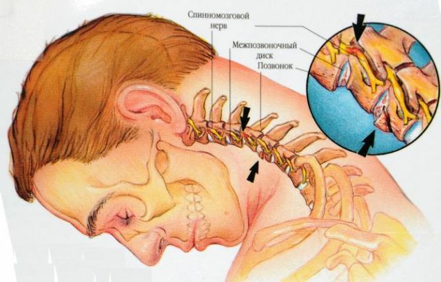 anatomi av cervikal ryggrad