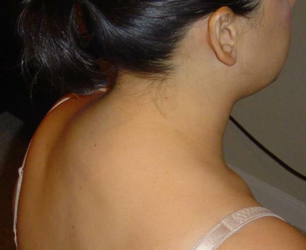 The deposition of salts on the neck