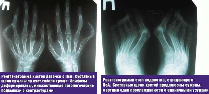 Psoriatic arthritis. X-ray signs, treatment methods, who treats, clinical guidelines