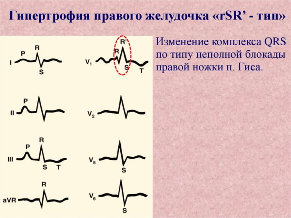 Right ventricular hypertrophy on the ECG. Signs, treatment