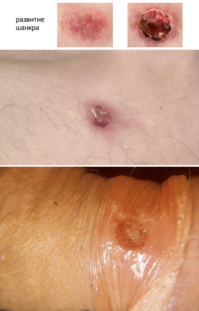Chancre with syphilis. Photo, how it looks hard, soft, hurts, itches