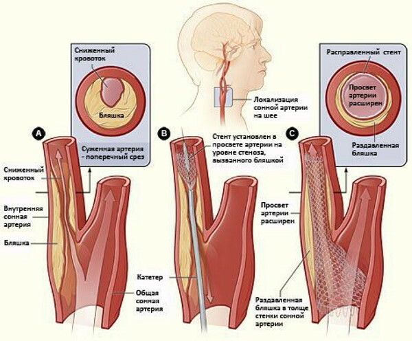 Vaskulær stenose i nakken. Symptomer og behandling, kirurgi