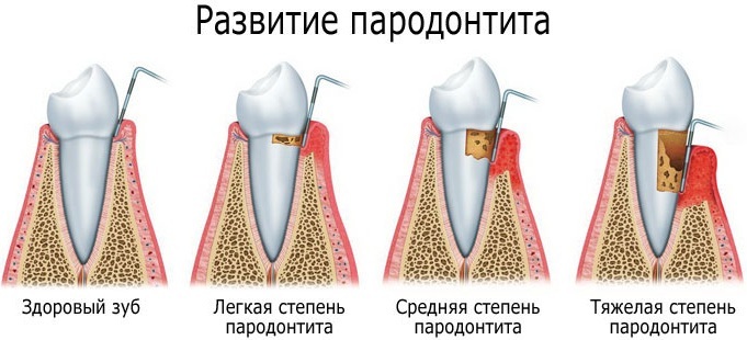 Dispositivo de vetor para o tratamento de periodontite, gengivas, limpeza de dentes em odontologia. O que é isso