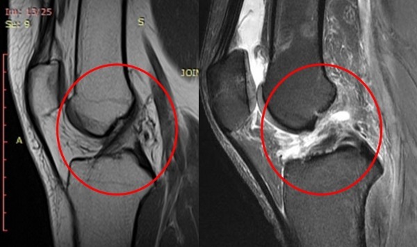 Anterior cruciate ligament. Anatomy, rupture, damage, changes, treatment